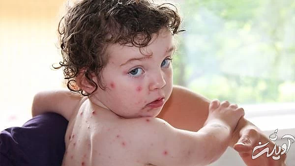 نشانه آبله مرغان